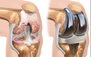 Before and After Knee Arthroscopy