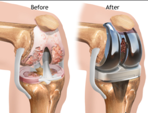 What to Expect Before, During, and After Knee Arthroscopy