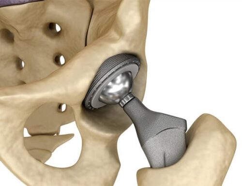 Hip Replacement: Myths vs. Facts