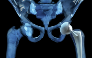 Hip Replacement Surgery