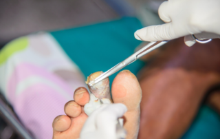 Orthopedic Treatment for Necrotic Foot