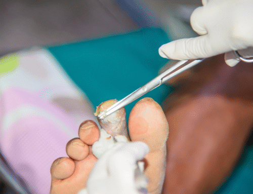 Necrosis of Feet: Warning Signs and How Orthopedic Treatment Preserves Mobility