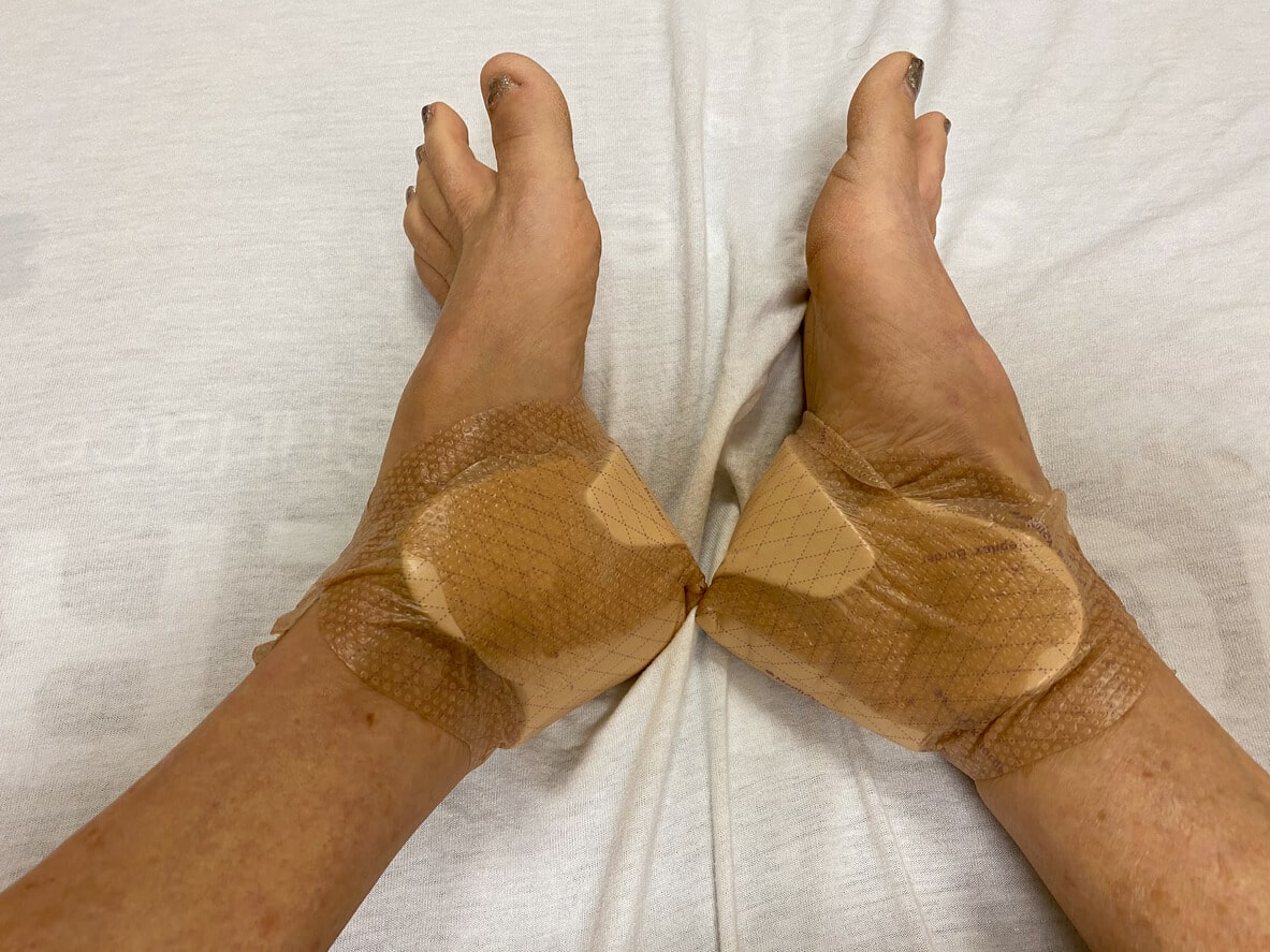 Orthopedic Treatment for Diabetes-Related Foot Infection