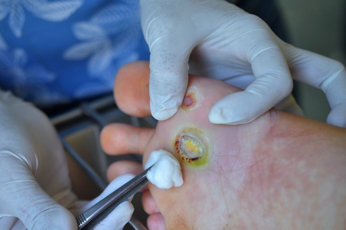 Orthopedic Treatment for Necrotic Foot